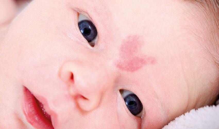 bebe avec une tache de naissance