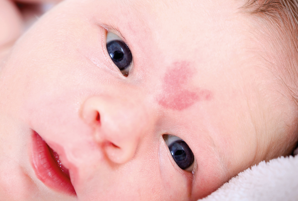 bebe avec une tache de naissance